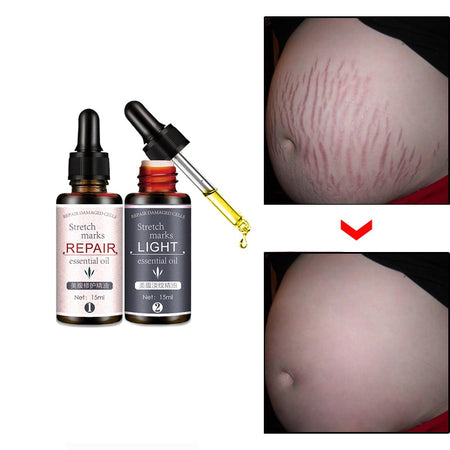 Stretch Marks Remover Essential Oil Skin Care Treatment Cream For Stretch Mark Removal Maternity Slackline For Pregnant Oils - Futurmama