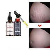 Stretch Marks Remover Essential Oil Skin Care Treatment Cream For Stretch Mark Removal Maternity Slackline For Pregnant Oils - Futurmama