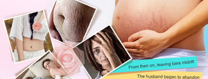 Stretch Marks Remover Essential Oil Skin Care Treatment Cream For Stretch Mark Removal Maternity Slackline For Pregnant Oils - Futurmama