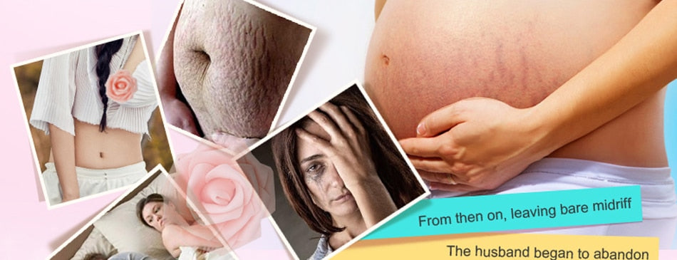 Stretch Marks Remover Essential Oil Skin Care Treatment Cream For Stretch Mark Removal Maternity Slackline For Pregnant Oils - Futurmama