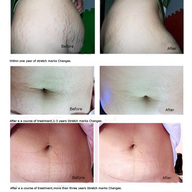 AFY Pregnancy Stretch Mark Removal Essential Oil Effective Maternity Natural Chinese Herbal Repairing Oil Get Rid Stretch Mark - Futurmama